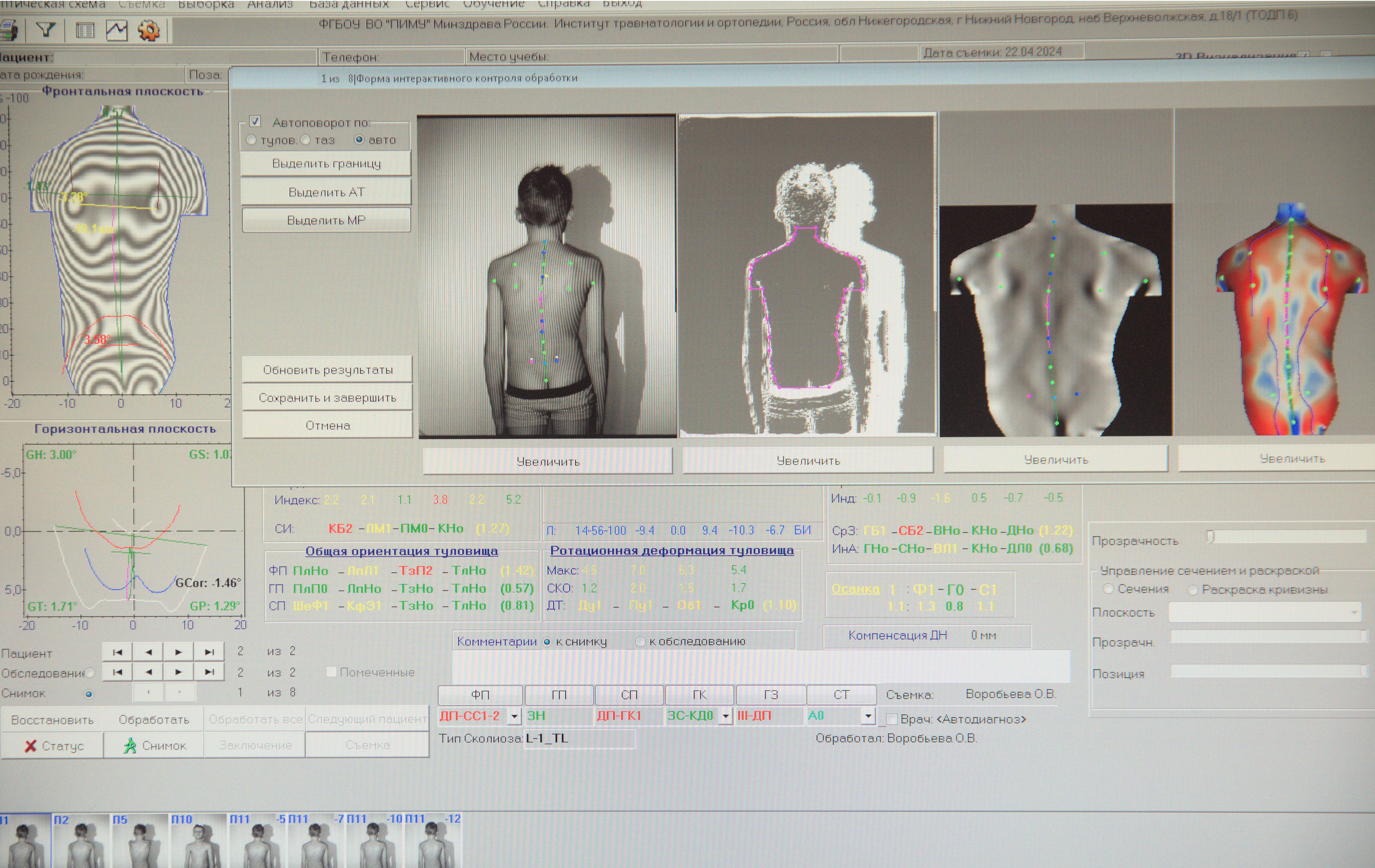 Топография позвоночника компьютерная оптическая