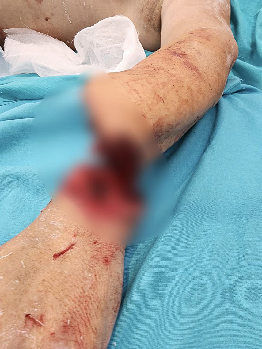 Врачи ПИМУ пришили отсеченную пилой часть руки пациента